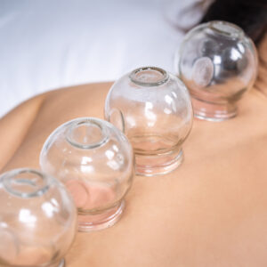 cupping treatment used in massage and acupuncture sessions