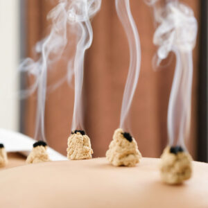 person receiving moxibustion treatment during an acupuncture session